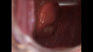 Avy Otvori Pickica sa Speculum